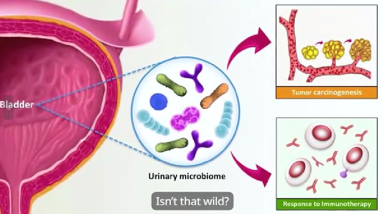 The Harmful Bacteria That Can Cause Sudden Urinary Leaks by Overstimulating Bladder Muscles