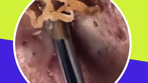 Blackhead removal new this week (ASMR) #10 #shorts