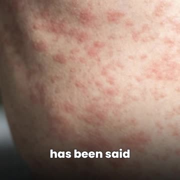 There’s not enough being said about these measles cases—
