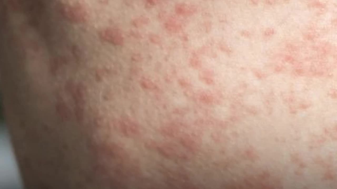 There’s not enough being said about these measles cases—