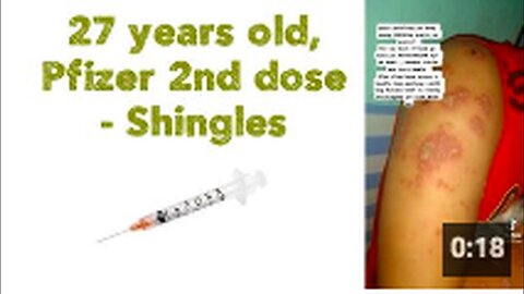 "27-Year-Old Receives Second Pfizer Dose, Develops Shingles"