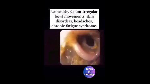 Unhealthy Colon