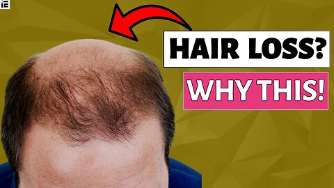 Root Causes why your hairline is RECEDING