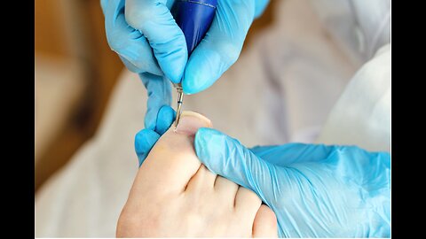 Ingrown Toenail Removal 2023 #ingrowntoenail #toenails #ingrown (21)