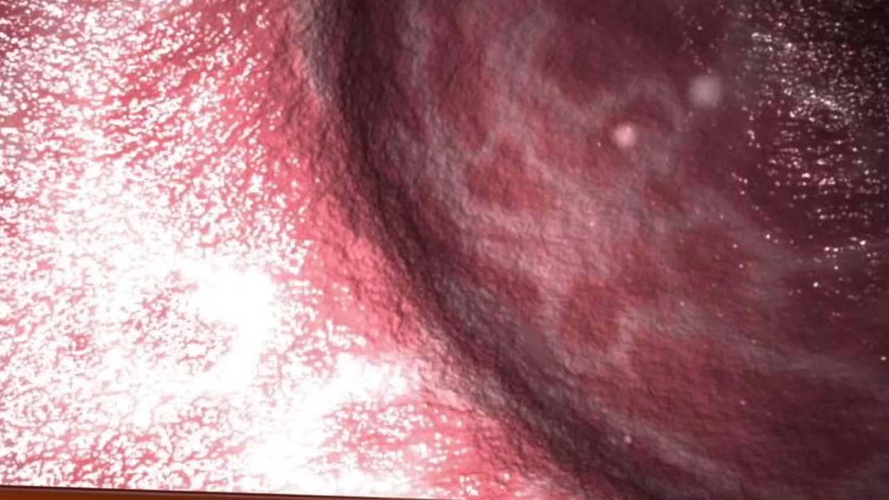 Colonoscopy Footage ₼ Watch This Polyp Removal!