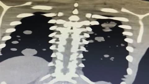 We have a new 21-year old…who now has Turbo Cancer from the ‘vaccine’.