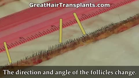 Dr. Brett Bolton Exposes the Truth About FUE Hair Transplants