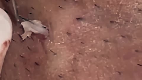 New satisfying blackhead removal #4