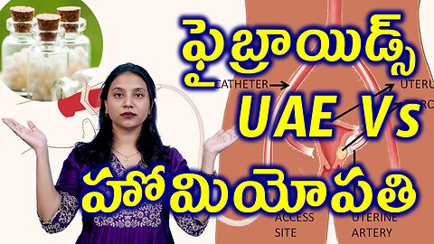 ఫైబ్రాయిడ్స్ Homeopathy Treatment Vs Uterine Artery Embolization UAE or Artery Blocking of Fibroids