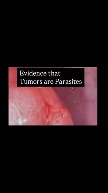 LOOK AT WHAT'S REALLY INSIDE CANCER TUMORS - PARASITES ☠️