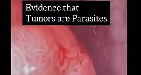 LOOK AT WHAT'S REALLY INSIDE CANCER TUMORS - PARASITES ☠️