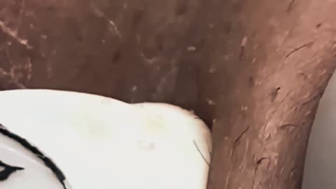 New satisfying blackhead removal #10