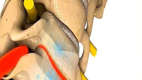 Spinal Decompression Therapy Instant Relief for Back Pain & Sciatica Is Done