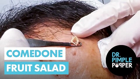 Comedone Fruit Salad