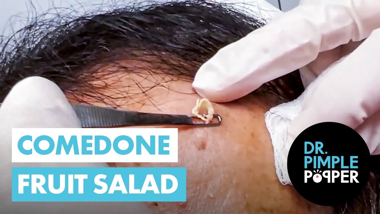 Comedone Fruit Salad