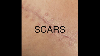 SCARS
