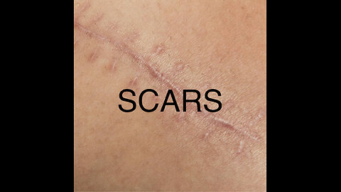 SCARS