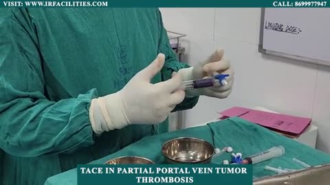 TACE in Partial Portal Vein Tumor Thrombosis | IRFACILITIES