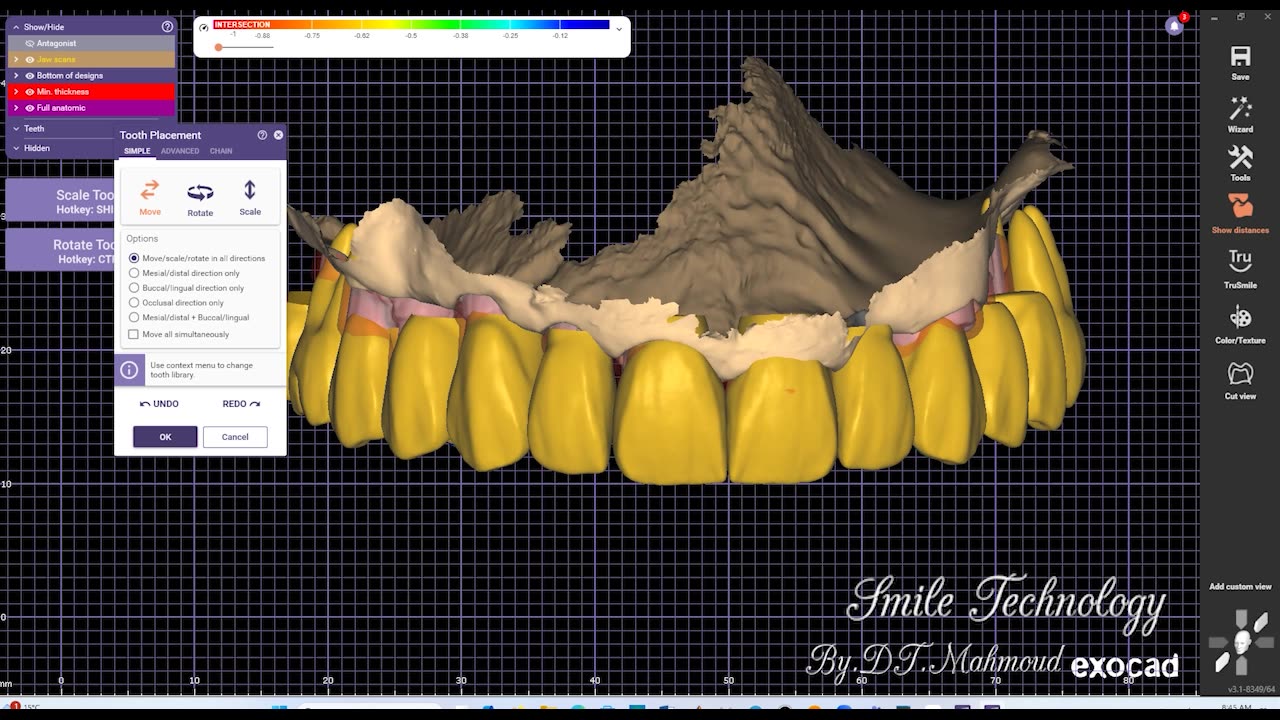 #design #naildesign #dental #dentaldesign #exocadexpert