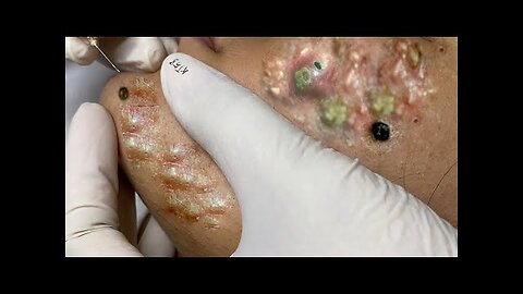 blackhead removal and Pimplepopper Spa relaxation #10123