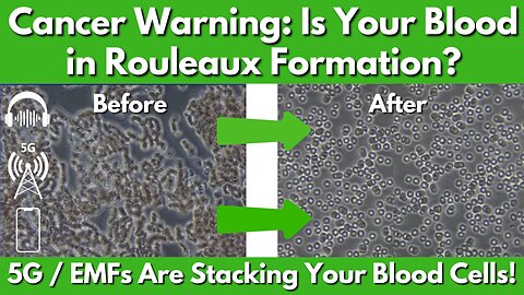 EMFs & Rouleaux: Is Your Blood Stacking Up for Disease?