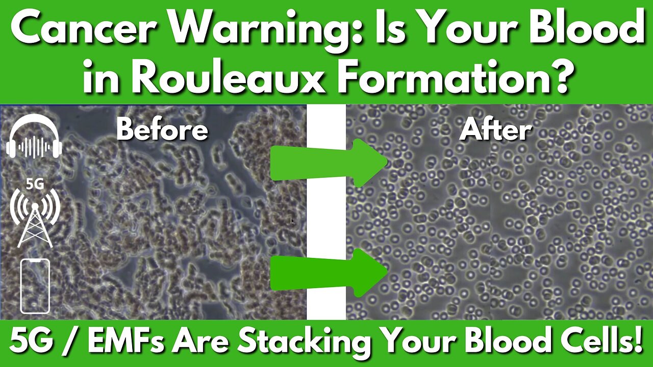 EMFs & Rouleaux: Is Your Blood Stacking Up for Disease?