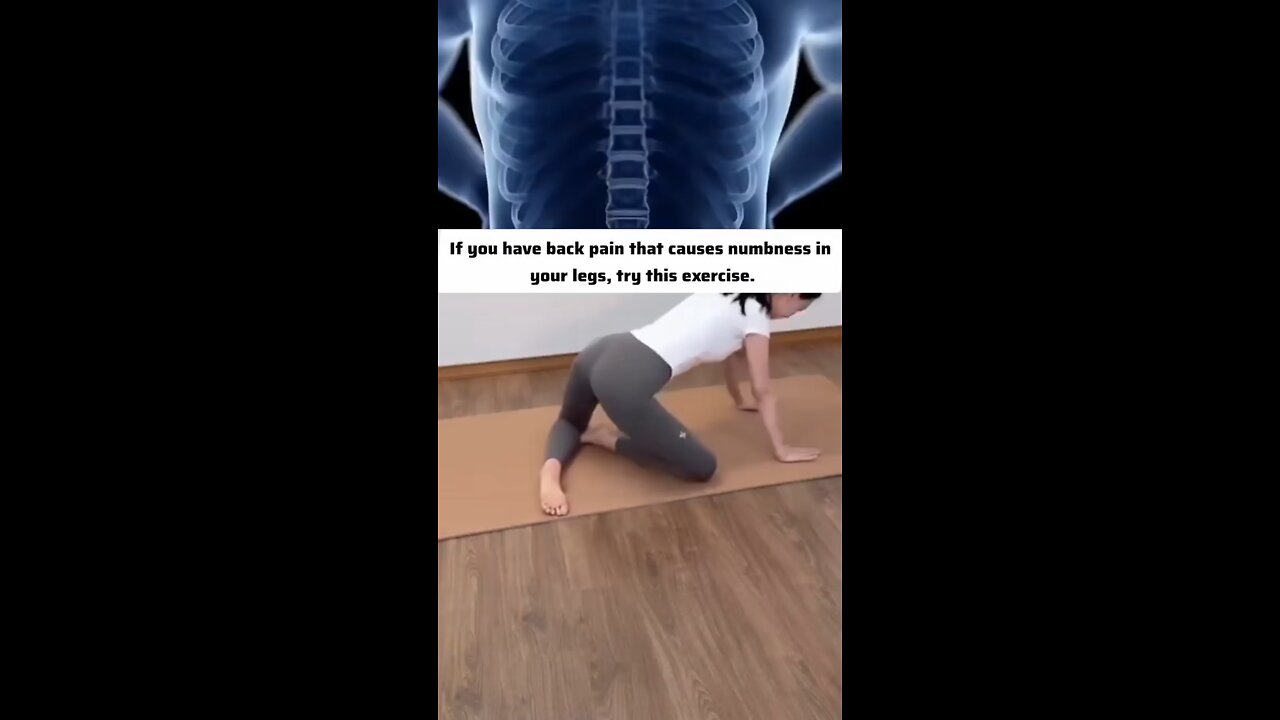 sciatica