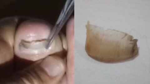 🚨DIY Surgery 101 - Dr. Billy Jones, Homeopathic Monk Surgeon - How to remove a toenail - LINKS!👀