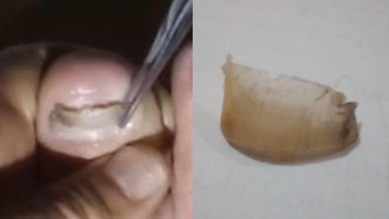 🚨DIY Surgery 101 - Dr. Billy Jones, Homeopathic Monk Surgeon - How to remove a toenail - LINKS!👀