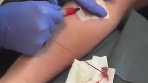 Live patient getting blood removed watches as a long, stringy clot comes out of her.