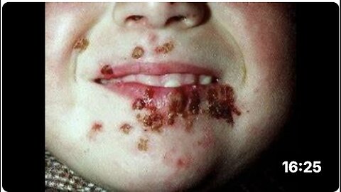 "Unveiling Herpes Virus: The Unspoken Knowledge by Dr. Sam Bailey"
