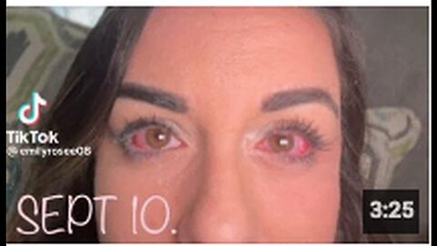 "Rare Reaction Caused by Diagnosis of Steven Johnson’s Syndrome"