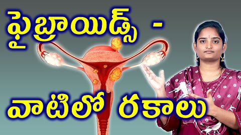 ఫైబ్రాయిడ్స్ రకాలు | Types Of Uterine Fibroids | Leiomyoma Best Homeopathy Treatment Medicine Cure