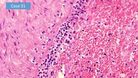 Dr. Arne Burkhardt: Autopsies Show The mRNA Vaccine SHREDS People From Within!