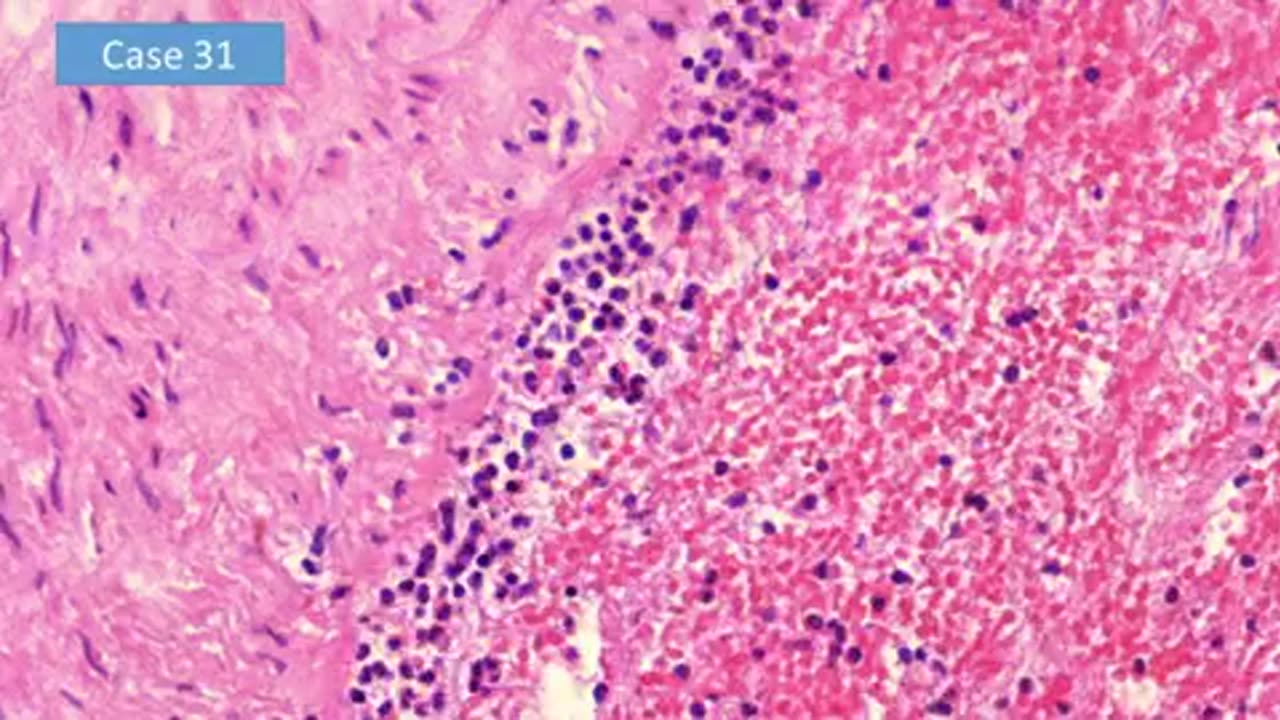 Dr. Arne Burkhardt: Autopsies Show The mRNA Vaccine SHREDS People From Within!