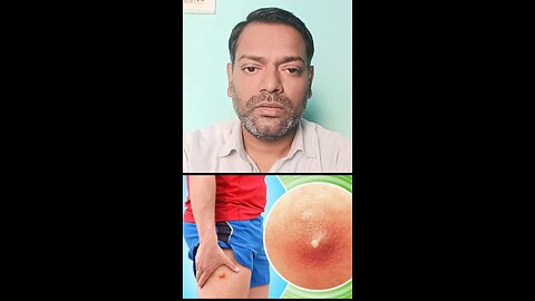 फोड़ा,फुंसी,बालतोड़ होने के कारण ।