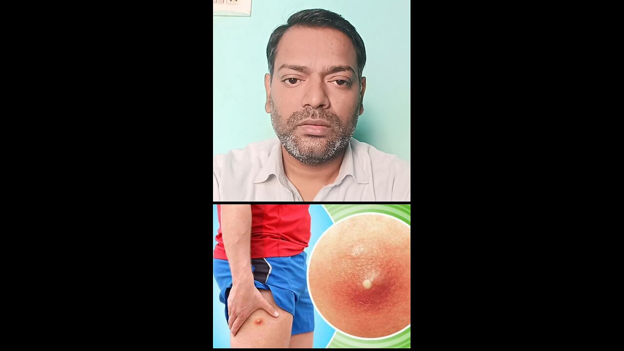 फोड़ा,फुंसी,बालतोड़ होने के कारण ।