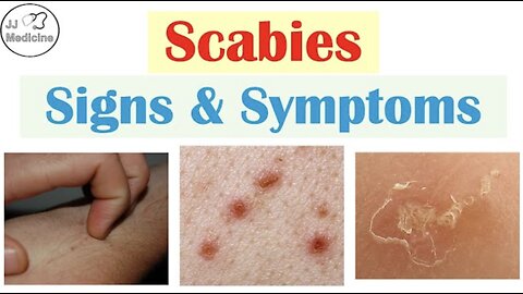 Scabies Signs and Symptoms (Some Pretty Crazy Ones!) & Why They Happen