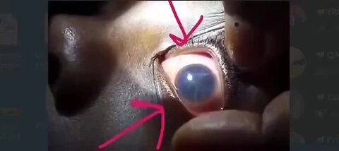 "Unprecedented Footage: Hydra Vulgaris Observed in Eye of Vaccinated 11-Year-Old"