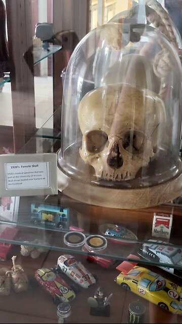 Helena, the real skull of a 1920's young female, with a healed over fracture on the forehead.