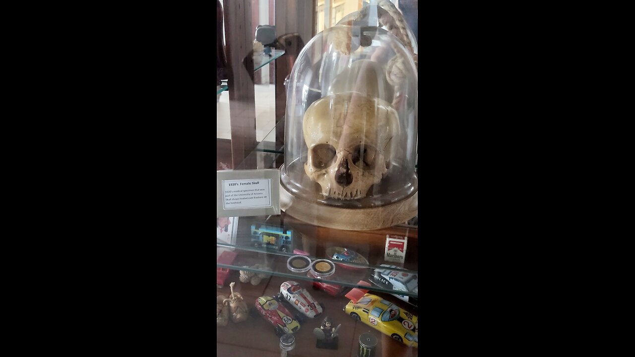 Helena, the real skull of a 1920's young female, with a healed over fracture on the forehead.