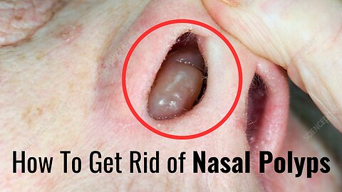 How to get rid of Nasal Polyps