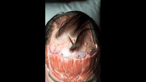 #3dmedico follow for more content