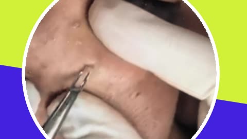 Blackhead removal new this week (ASMR) #20 #shorts