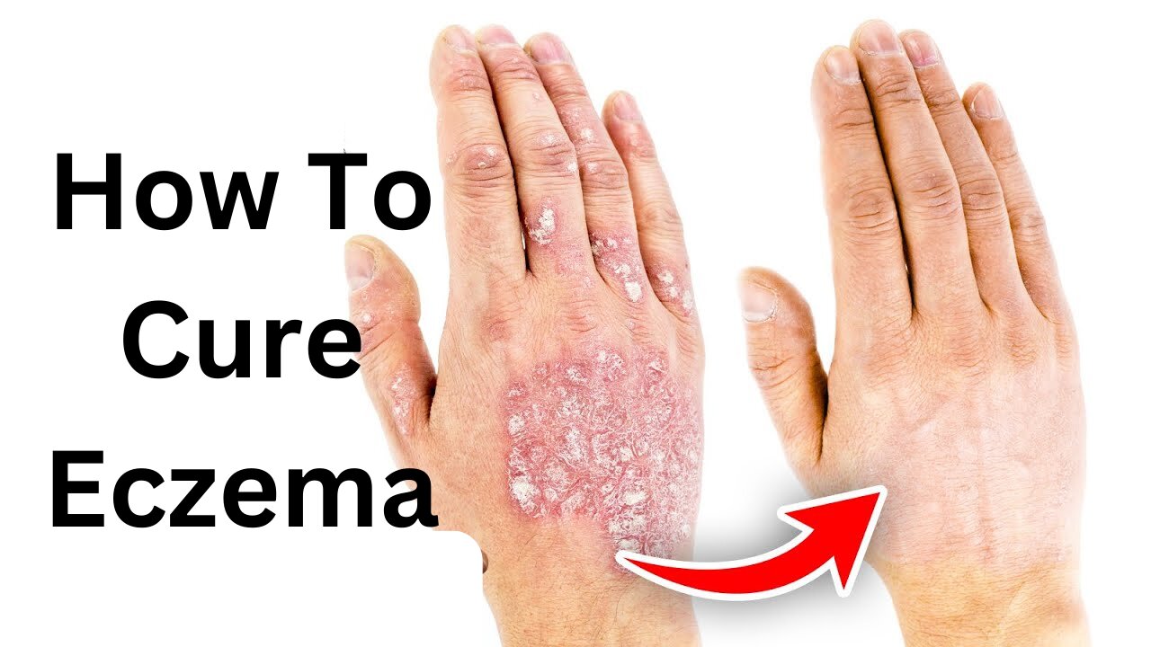 How to get rid of Eczema and Itchy Skin