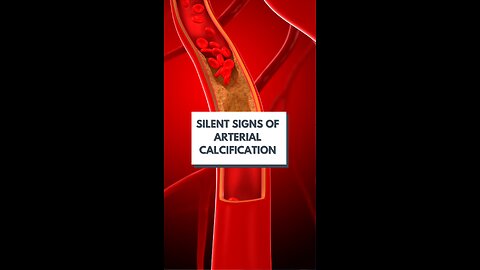 Could You Have Arterial Calcification Without Knowing It?