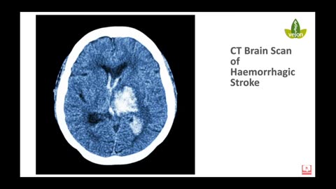 VAX SPIKE Protein Lingers in Brain Arteries for MONTHS.
