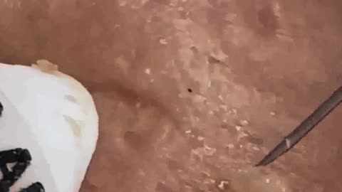 New satisfying blackhead removal #2