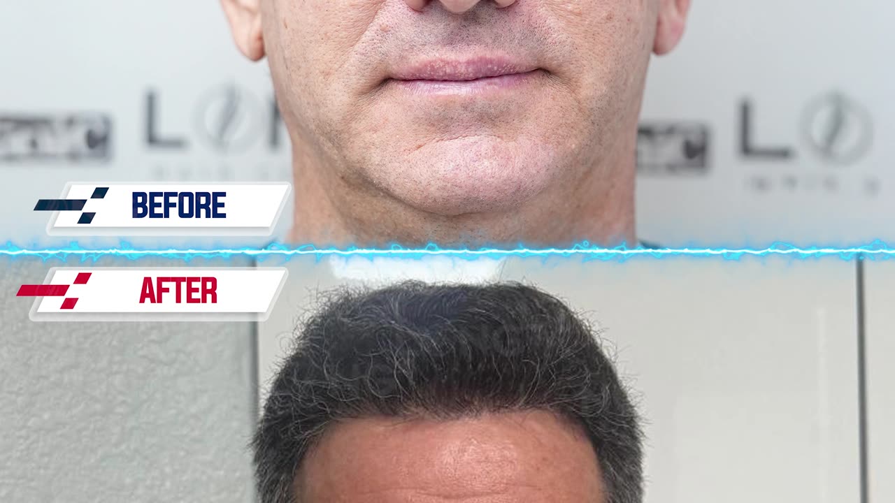 There is no need to worry about receding hairlines any longer.