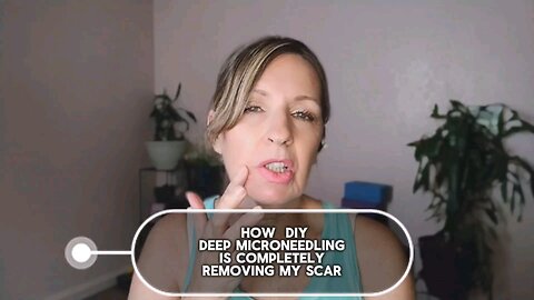 DIY Microneedling is Removing my Scar!